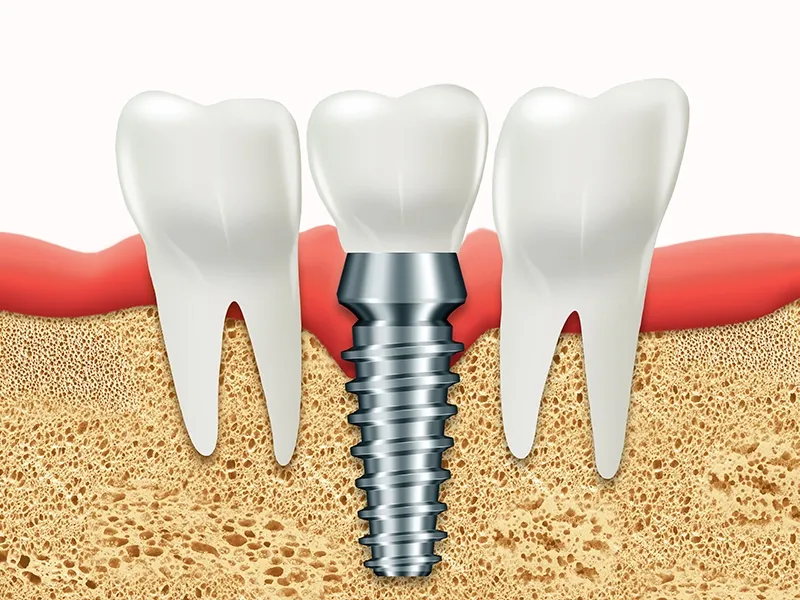 Comparison of Implants with Other Treatment Alternatives